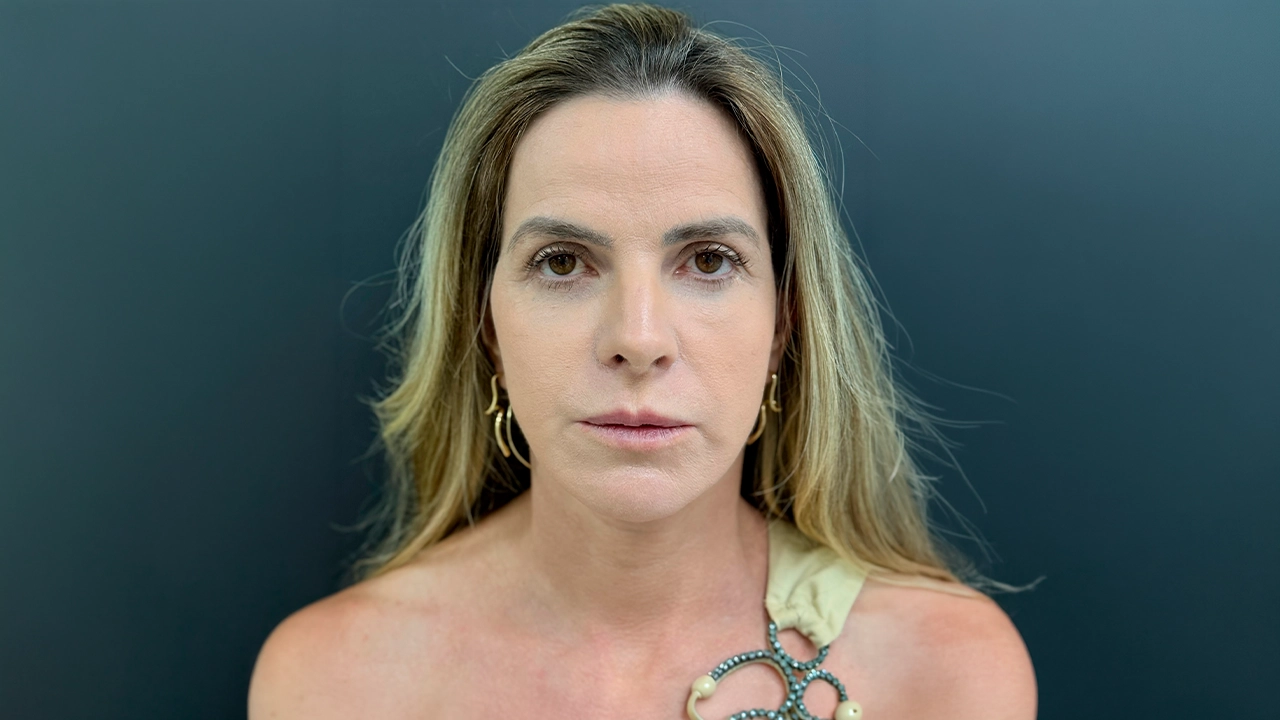 Resultado depois